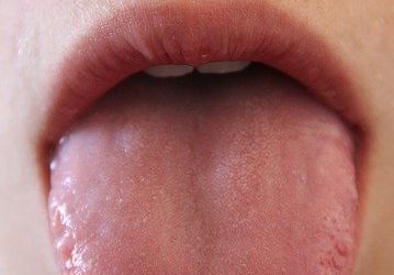 Hast du schon einmal etwas über Bänder im Mund gehört?